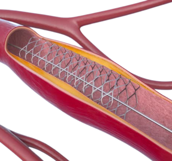 l’angioplastie