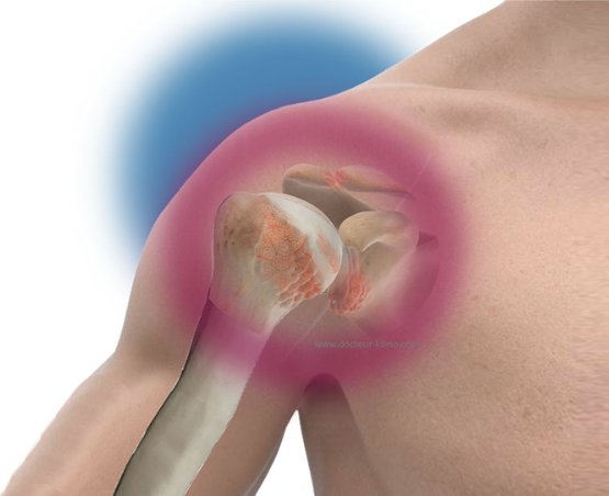 chirurgie de l’épaule