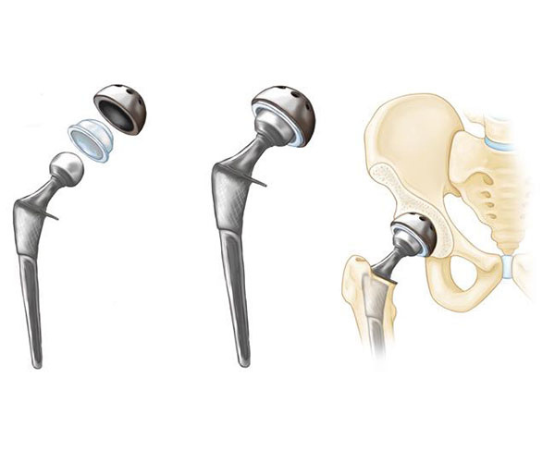 prothèse de la hanche